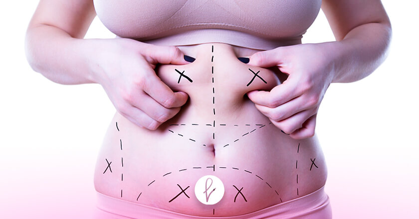 ¿La cirugía de abdomen es un buen tratamiento para la obesidad?
