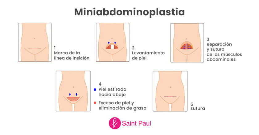 ¿Qué es la miniabdominoplastia?