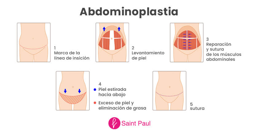 Principales diferencias entre miniabdominoplastia y abdominoplastia: