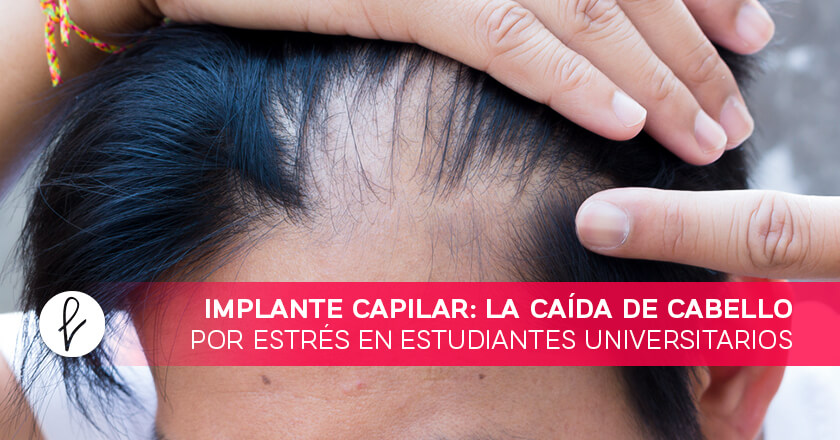 Implante Capilar: La caída de cabello por estrés en estudiantes universitarios
