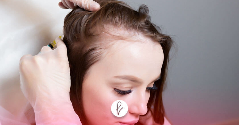 ¿Qué es la carboxiterapia Capilar?