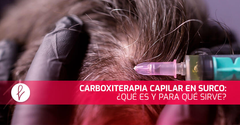 Carboxiterapia Capilar en Surco: ¿Qué es y para qué sirve?