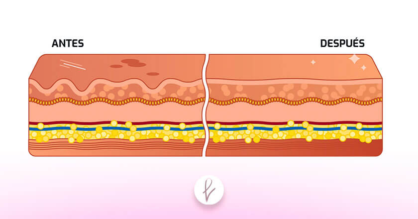 ¿Qué hace el plasma inyectado?