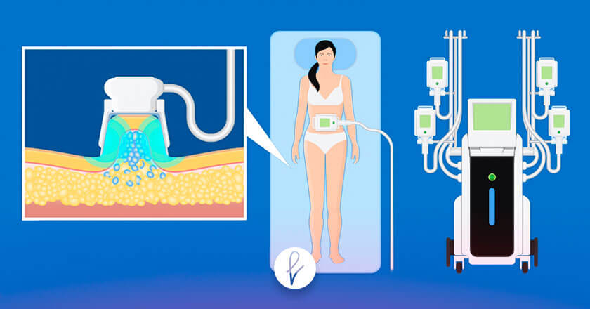 Pasos a seguir durante el procedimiento Pasos a seguir durante el procedimiento