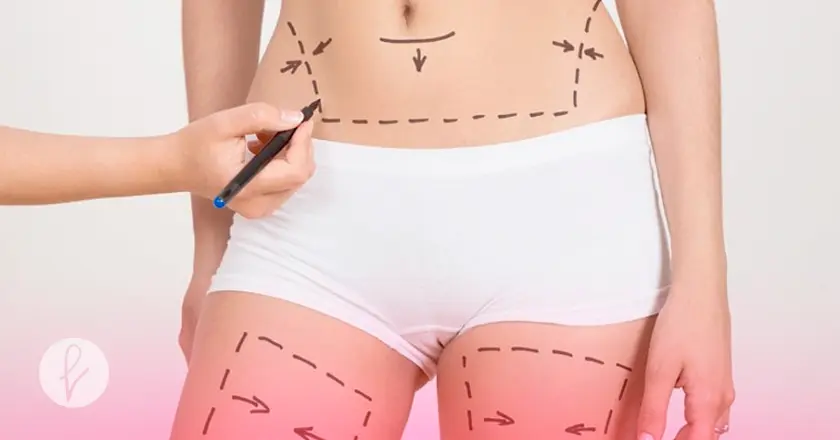 ¿En qué Consiste la Lipoescultura?