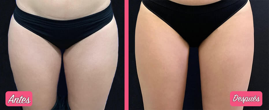 Resultados de la Liposucción de Muslos