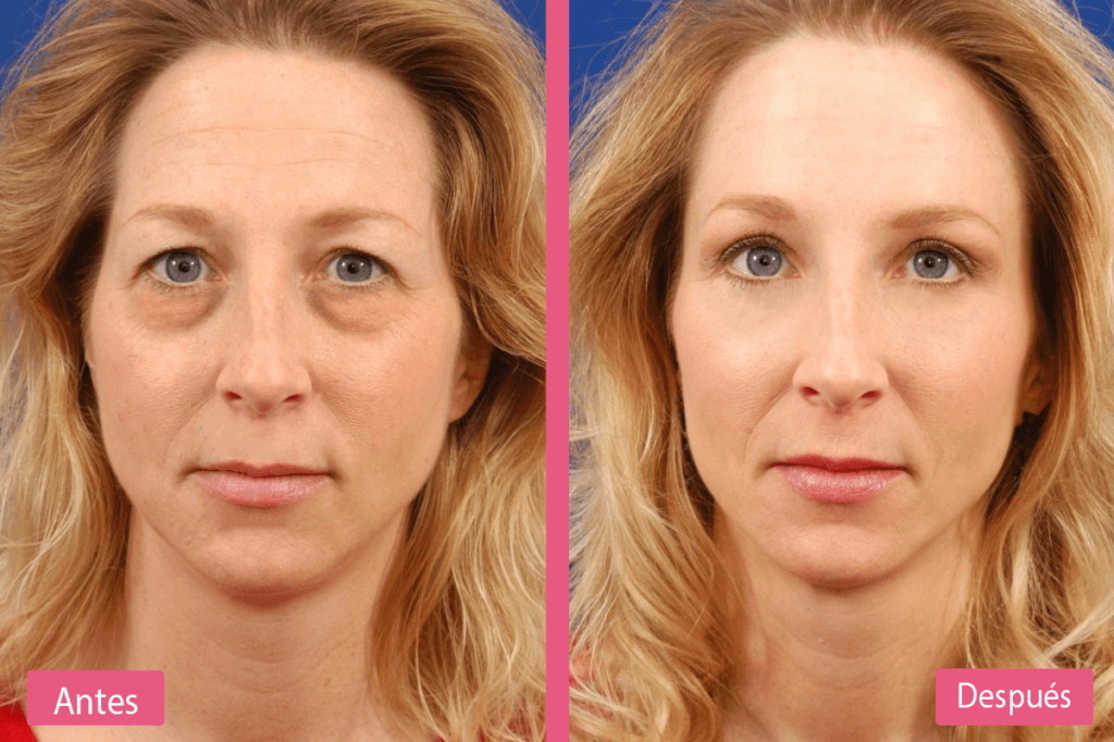 Resultados de una Blefaroplastia Transconjuntival Resultados de una Blefaroplastia Transconjuntival