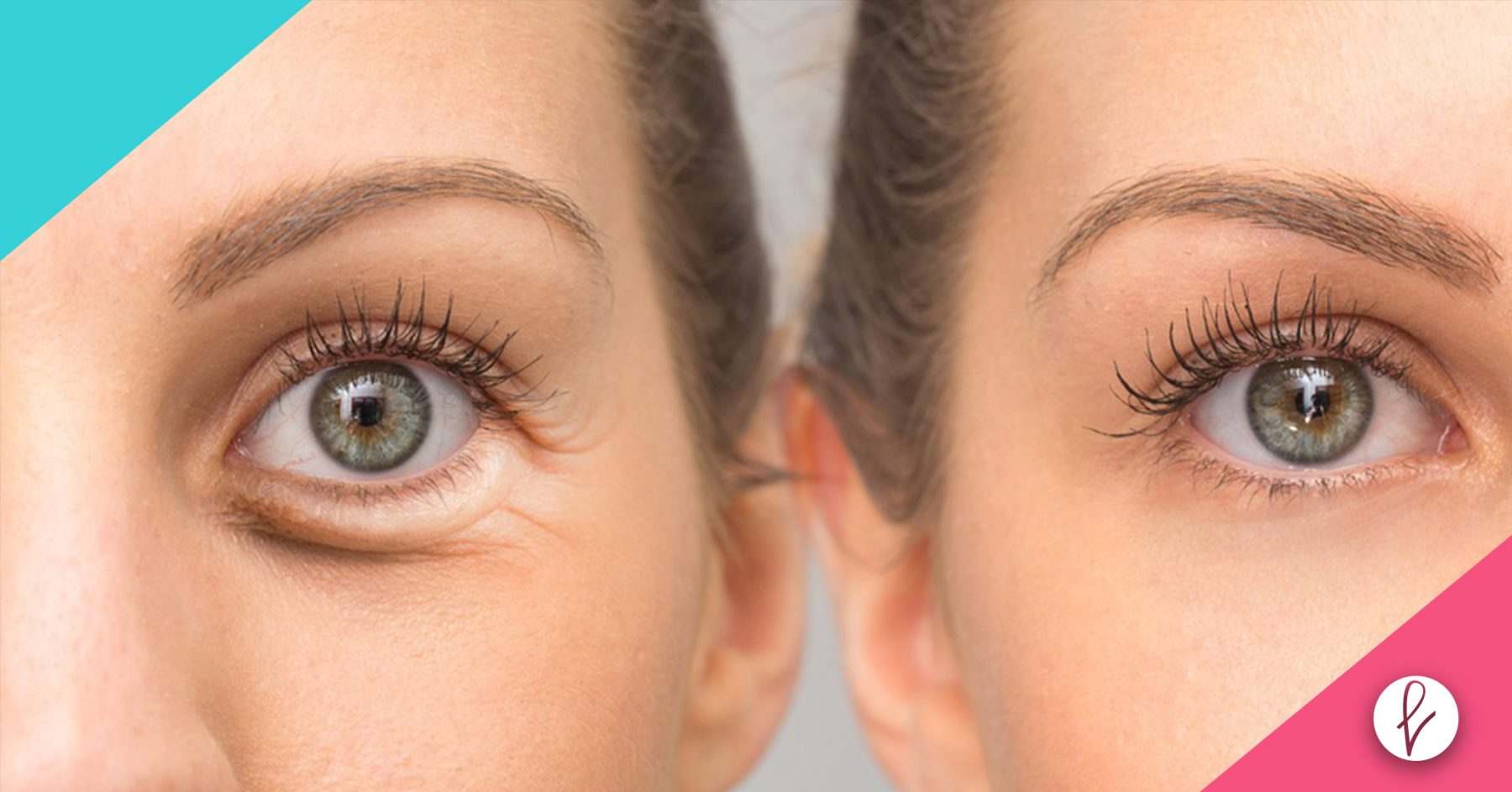 Blefaroplastia Convencional vs Láser: ¿Cuál es mejor?