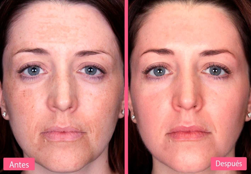 Tratamientos Sin Agujas Tratamientos Sin Agujas