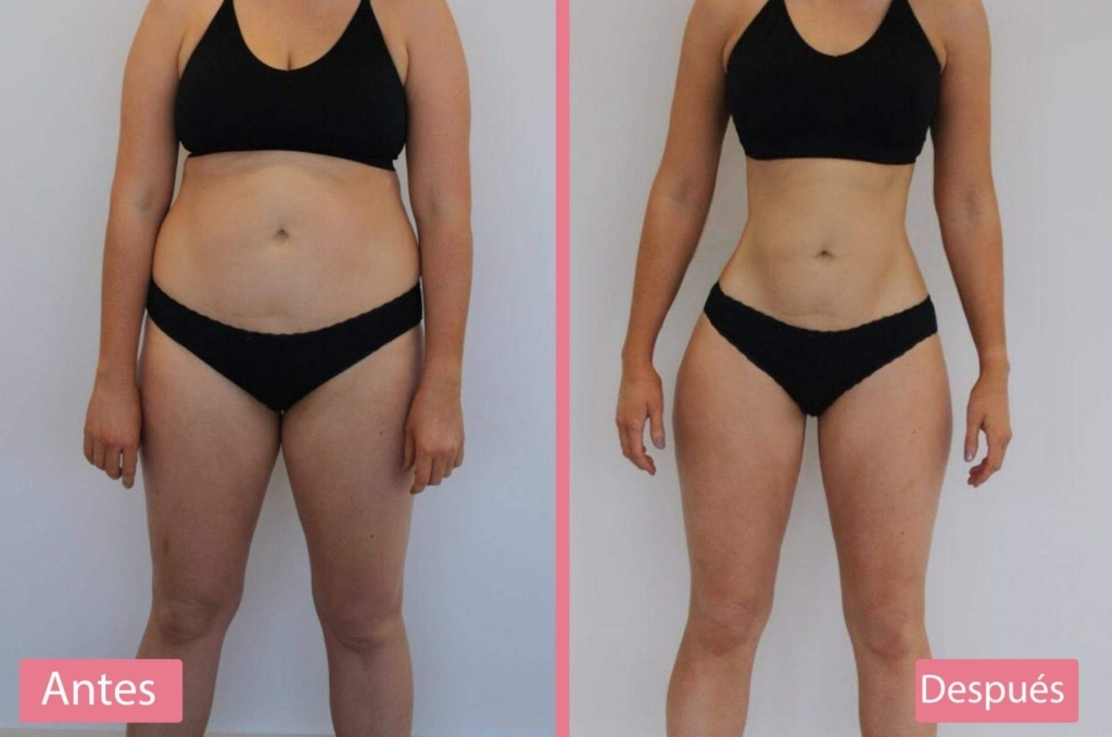 Resultados de la Lipoabdominoplastia