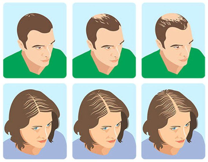 diferencias entre alopecia femenina y masculina
