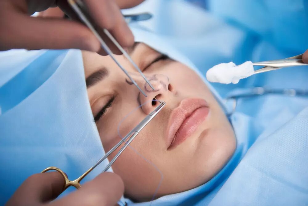 ¿Por qué falla una Rinoplastia?