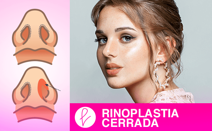 Rinoplastia cerrada