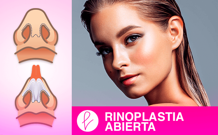 Rinoplastia abierta