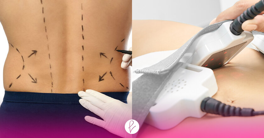 Tipos de Lipoescultura para Hombres Tipos de Lipoescultura para Hombres