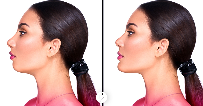 Cuidados pre y postoperatorios de Mentoplastia