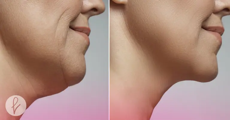 lipopapada elimina la grasa
