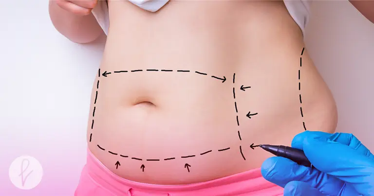 ¿Qué es la abdominoplastia? ¿Qué es la abdominoplastia?