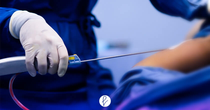 ¿La liposucción conlleva riesgos o consecuencias fatales?