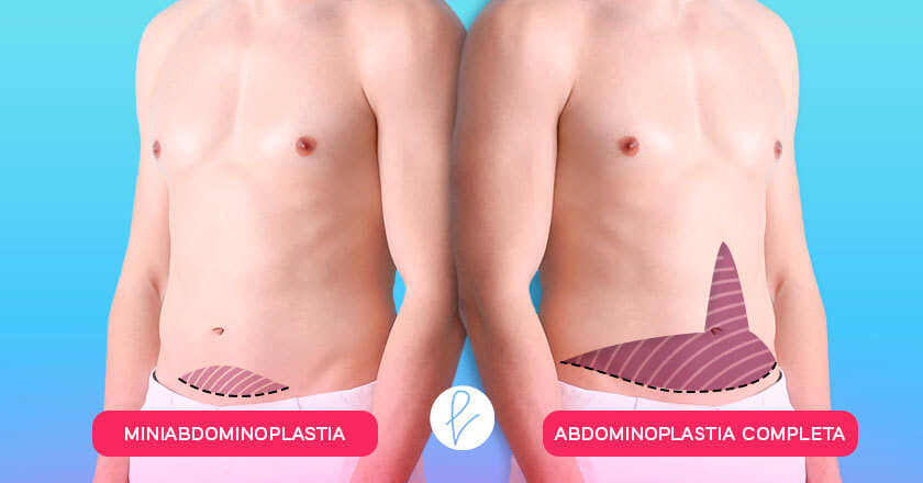 ¿Cómo es la abdominoplastia en hombres?