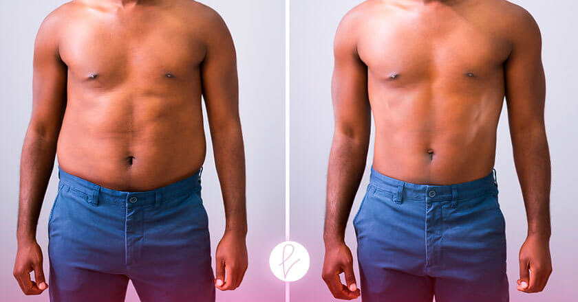 Resultados de la cirugía de abdominoplastia