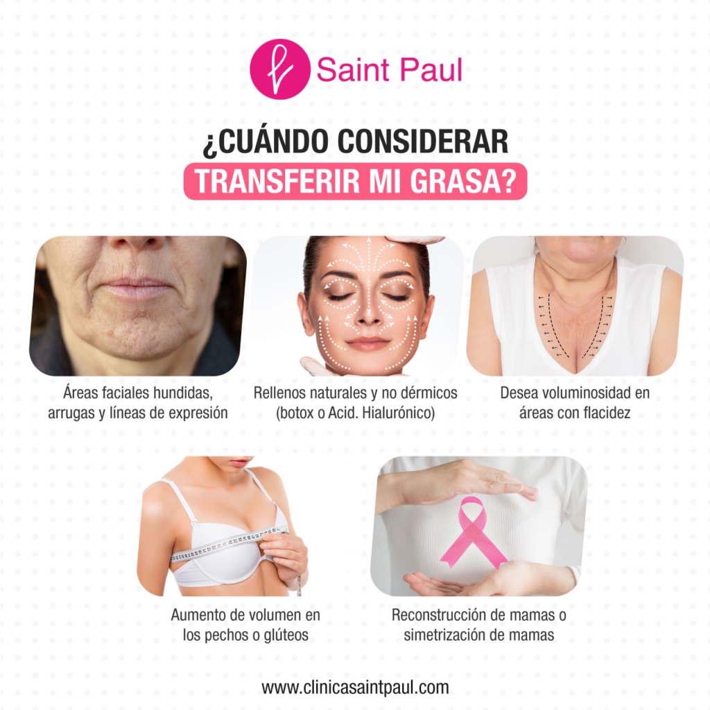 ¿Cuándo considerar transferir mi grasa?