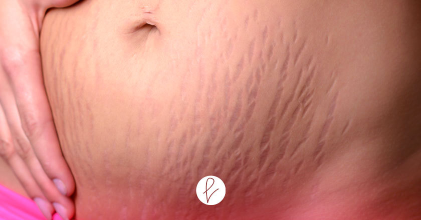 ¿Quién tiene riesgo de tener estrías?