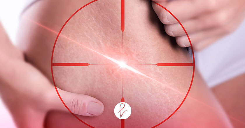 ¿Cómo eliminar las estrías del cuerpo?