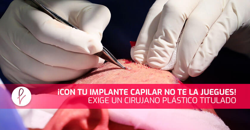 ¡Con tu Implante Capilar no te la juegues! Exige un cirujano plástico titulado