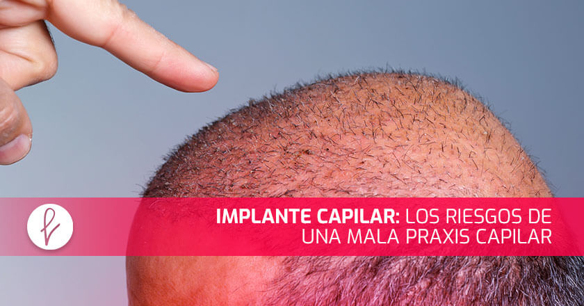 Implante Capilar: Los riesgos de una mala praxis capilar