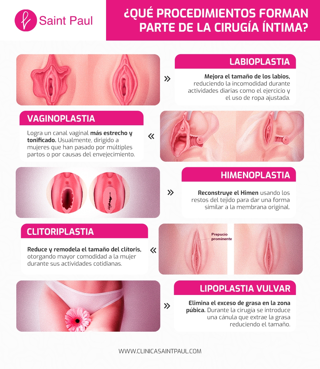 ¿Qué procedimientos forman parte de la cirugía íntima?