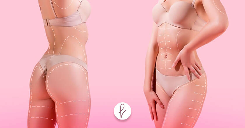 ¿Qué es una lipo 360?