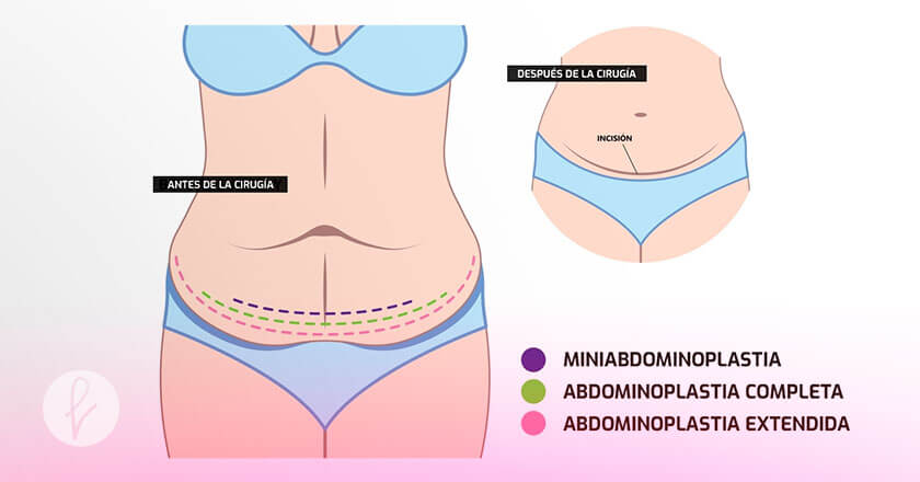 Tipos de Abdominoplastia