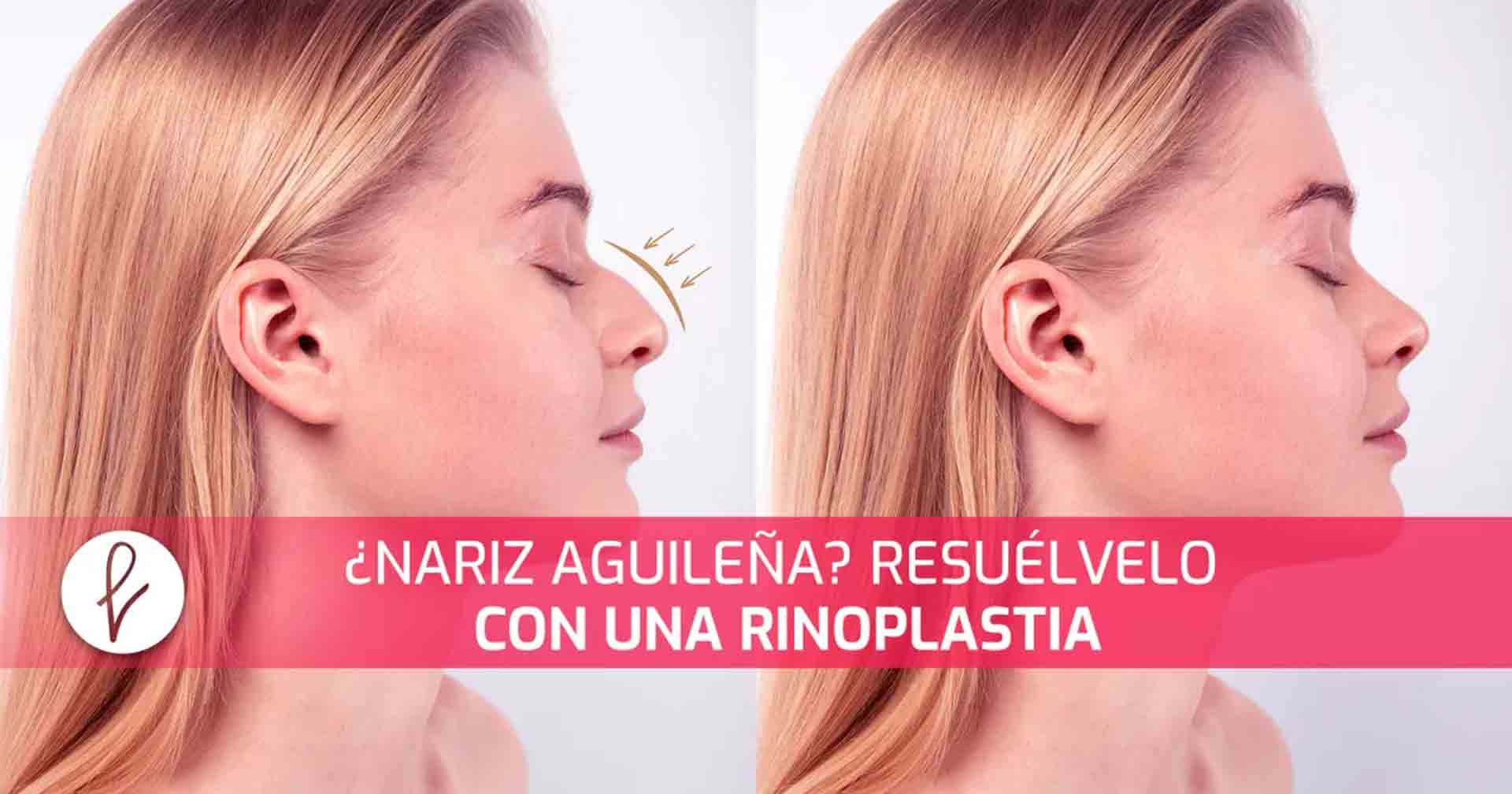 ¿NARIZ AGUILEÑA? RESUÉLVELO CON UNA RINOPLASTIA