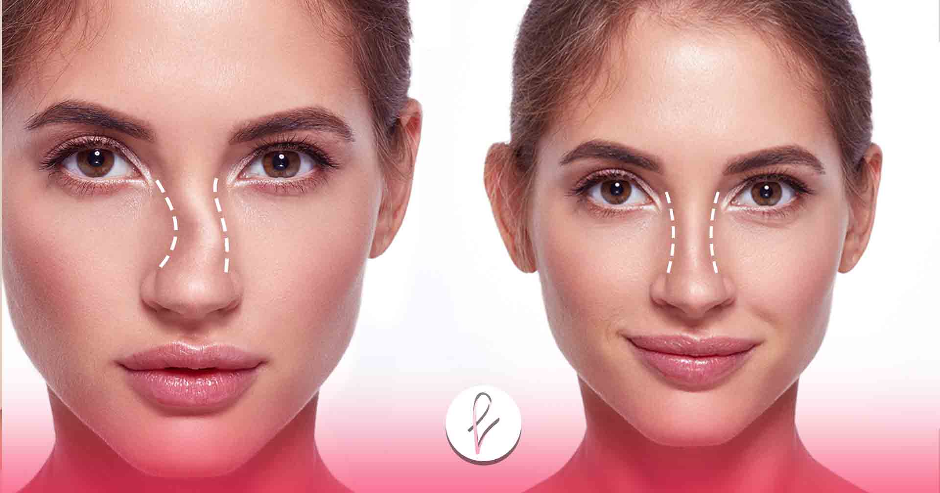 ¿Dónde Realizarse la Rinoseptoplastia?