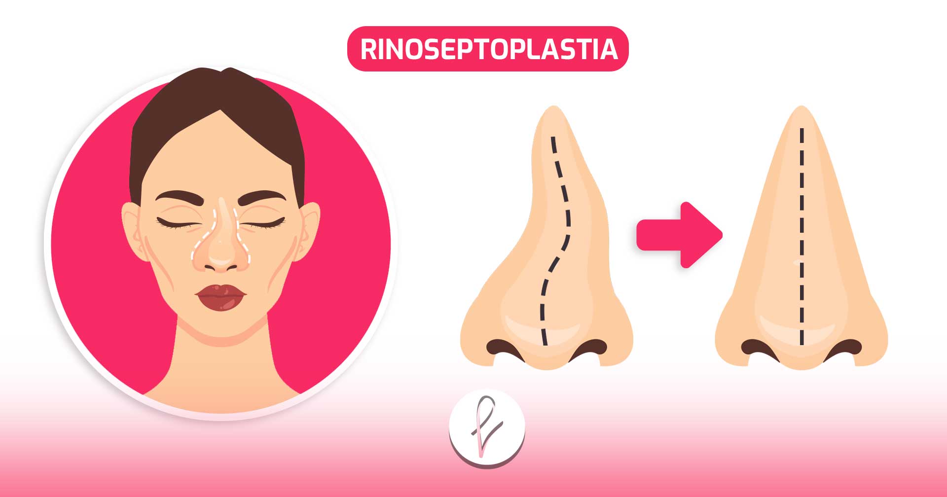 Rinoseptoplastia