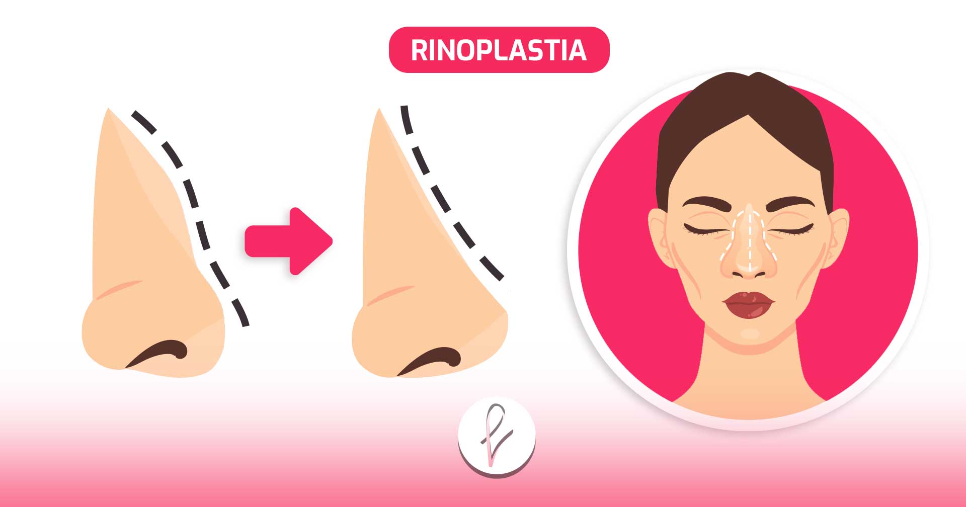 Rinoplastia