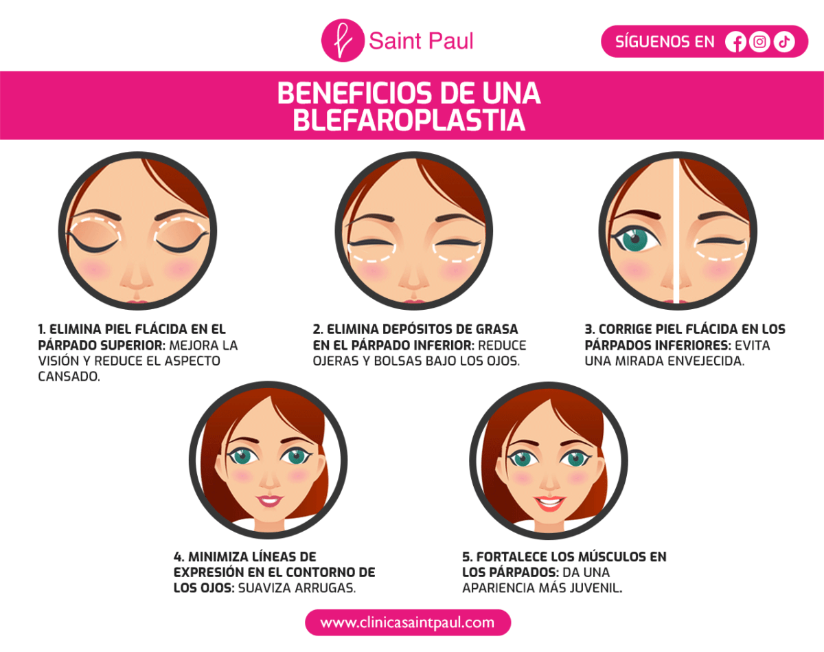 Cuándo debes Realizarte una Blefaroplastia: Guía Completa