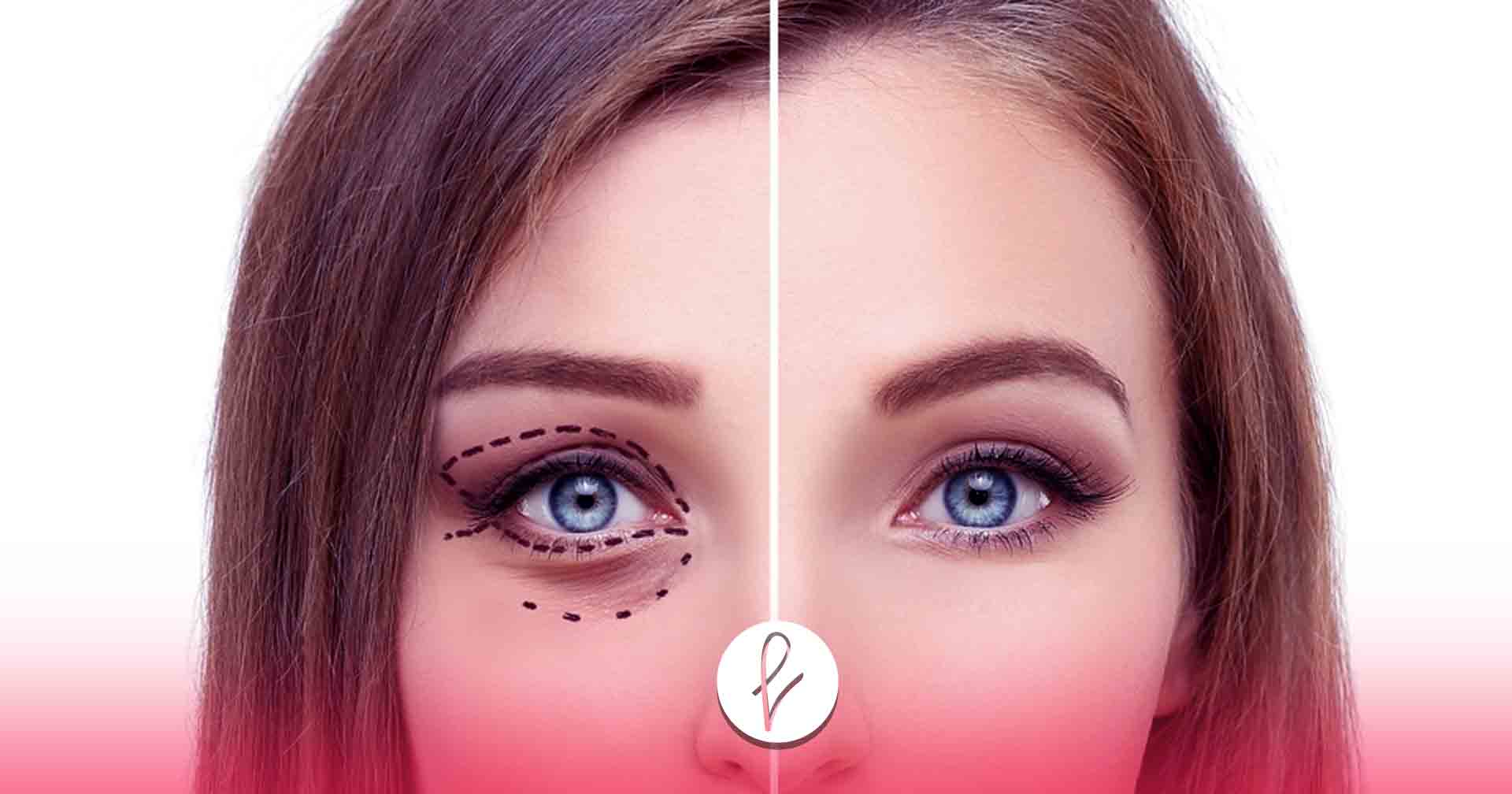 ¿Cuánto cuesta una Blefaroplastia en Lima?