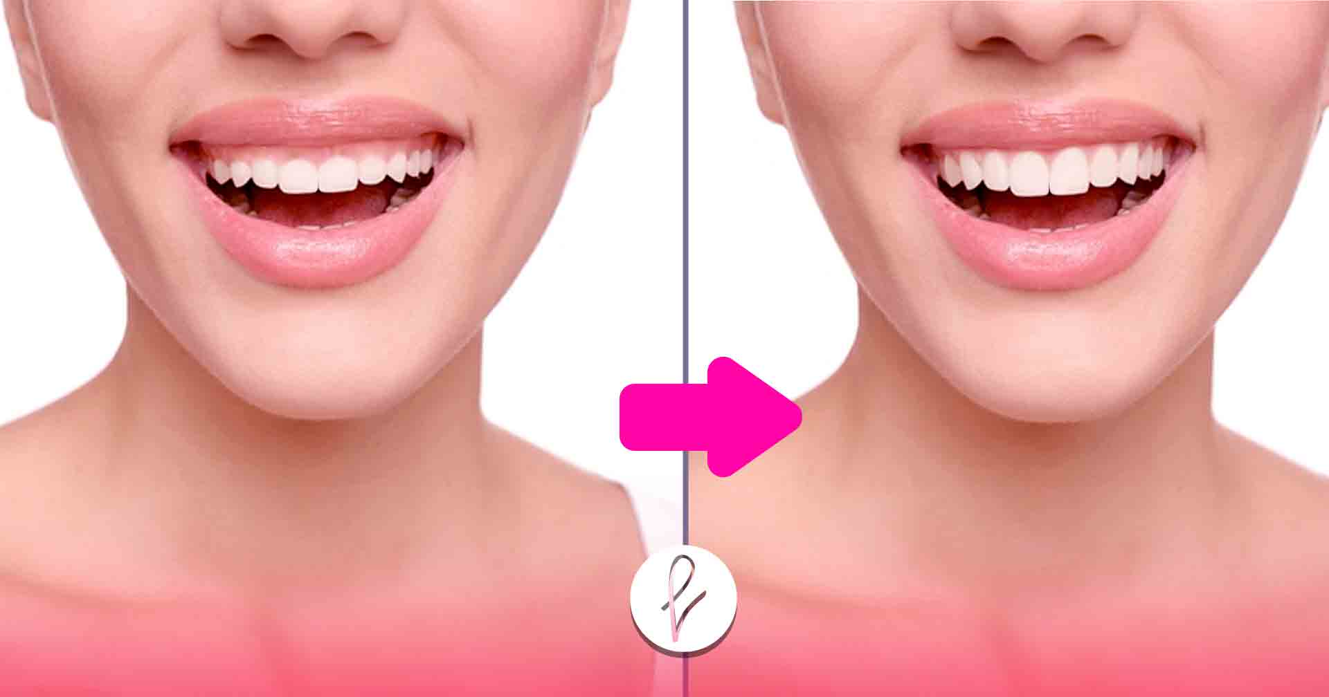 ¿Qué es la sonrisa gingival?
