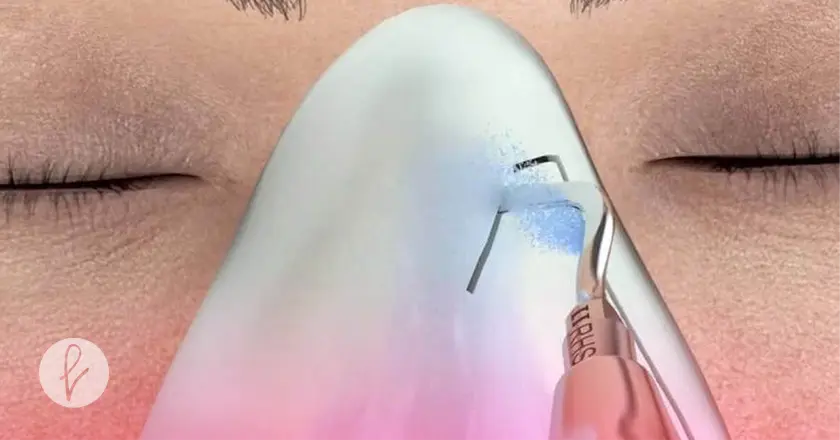 ¿Cuáles son las desventajas de la rinoplastia ultrasónica?