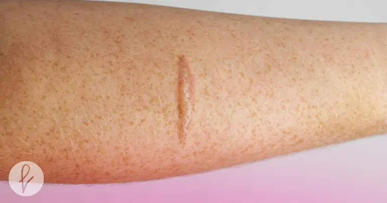 Procedimiento para eliminar la cicatriz queloide