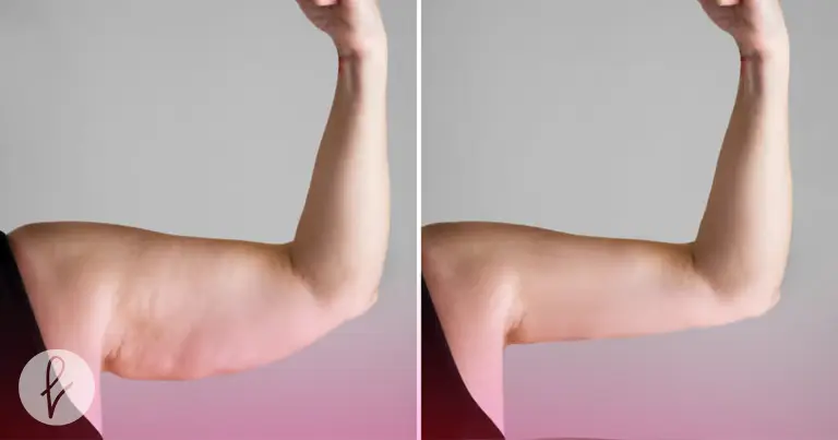 ¿Qué es el lifting de brazos?