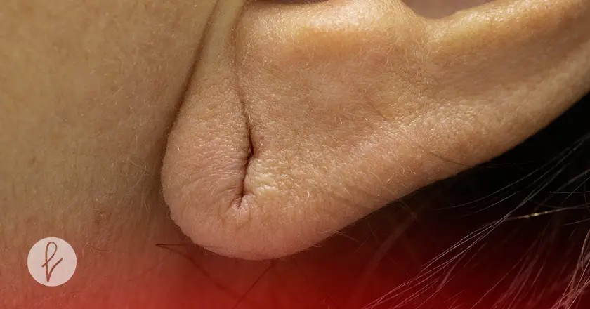 ¿Qué es la lobuloplastia?