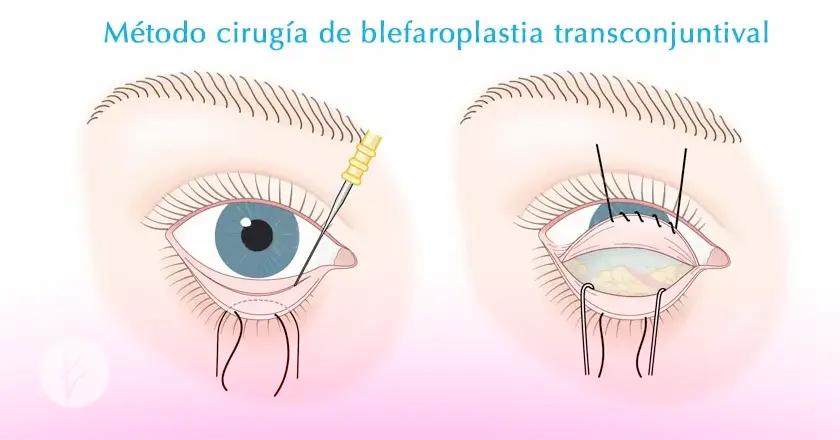 Beneficios de la blefaroplastia