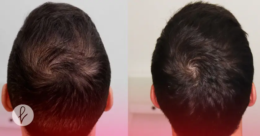 Cuidados posteriores al tratamiento