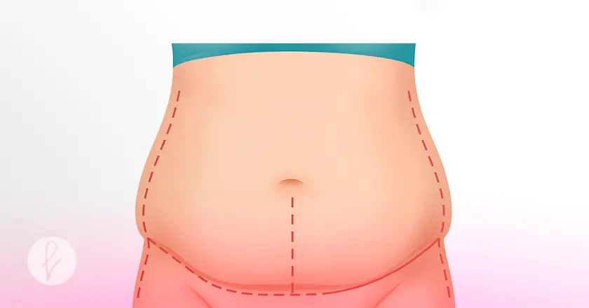 ¿Qué es la Abdominoplastia Extendida?