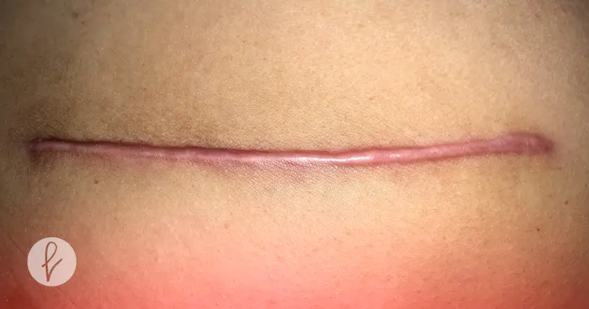 ¿Qué es la Corrección de Cicatrices Faciales?