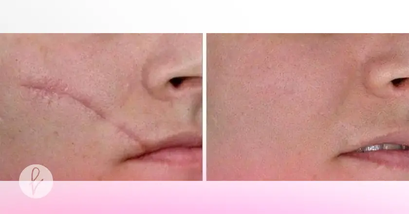 Beneficios de la Corrección de Cicatrices Faciales