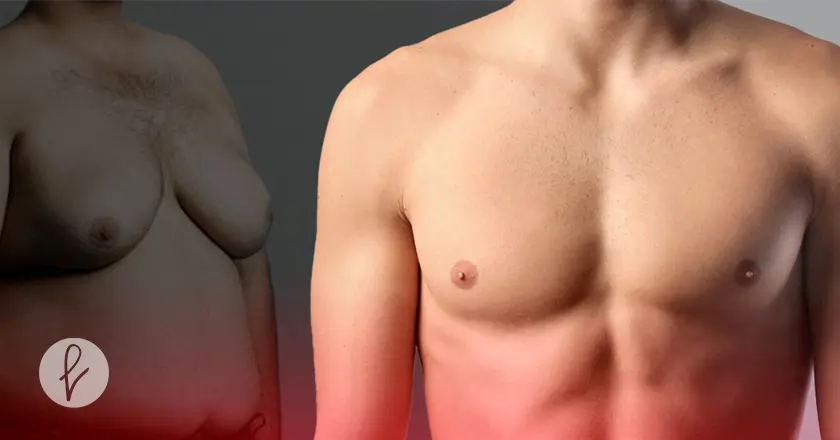 ¿Qué es la Corrección de la Ginecomastia Masculina?